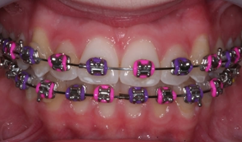 coloured metal braces